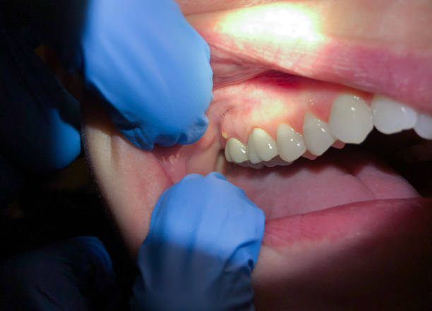 Best Emergency Dentist for Lost Fillings or Crowns in Blanco, TX
